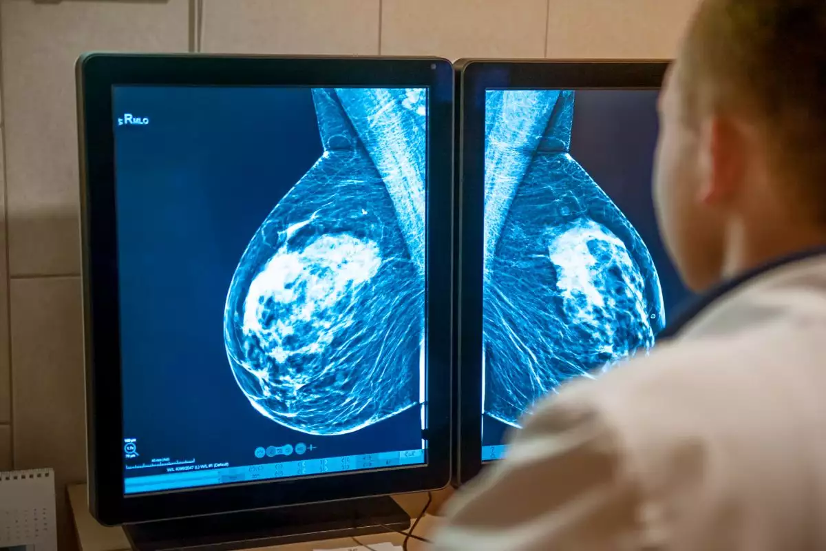 AGU processa médico por fake news sobre mamografia