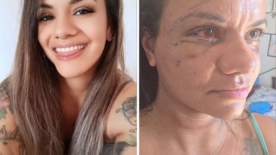 Mulher espancada com 61 socos exibe rosto após cirurgias de reconstrução
