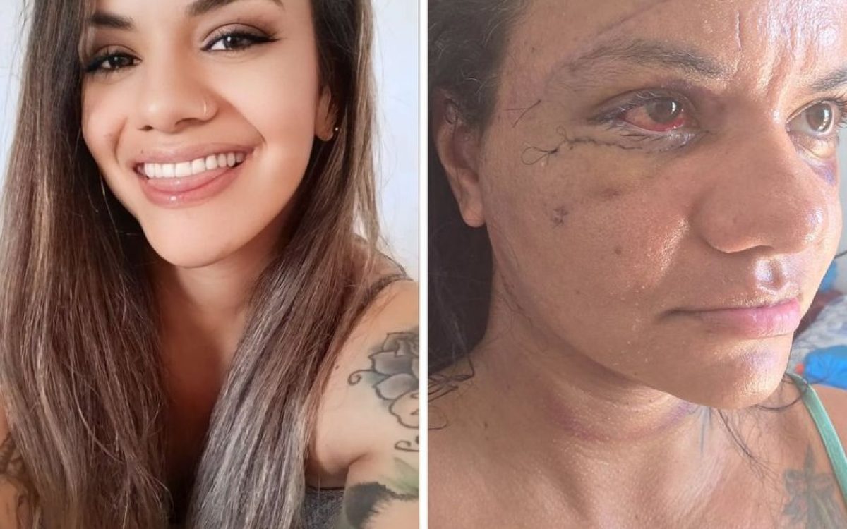 Mulher espancada com 61 socos exibe rosto após cirurgias de reconstrução