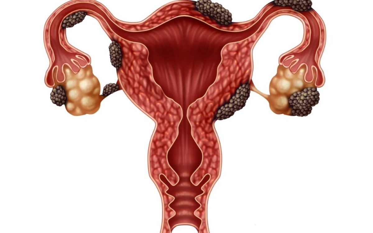 Endometriose – ginecologista alerta sobre riscos de infertilidade causadas pela doença